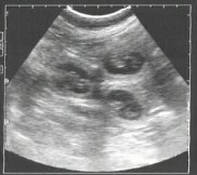 Das Ultraschall Bild nach dem 30 Tag